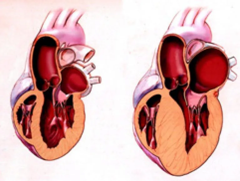 Hipertrofia ventricular esquerda